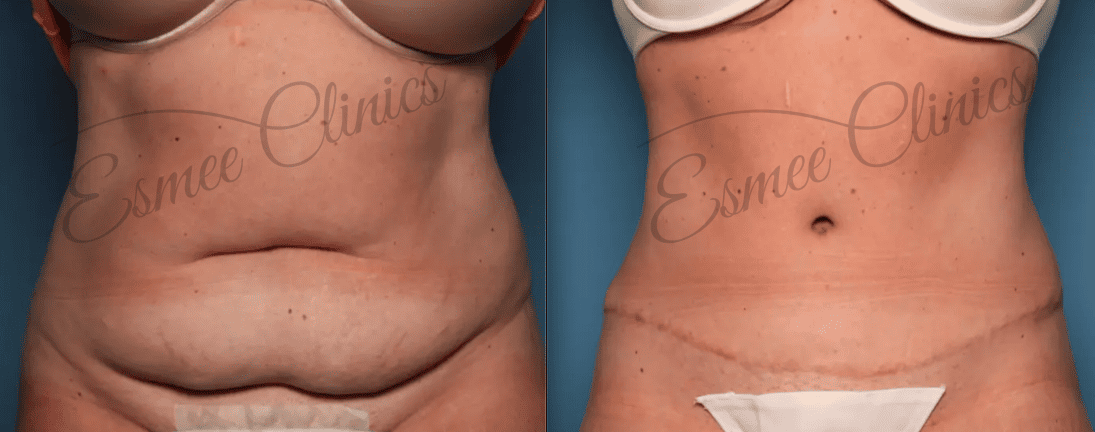 Before and After img